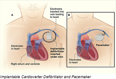 Implantable Cardioverter Defibrillator and Pacemaker