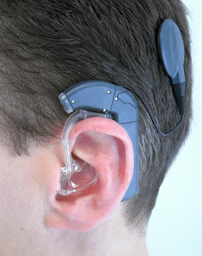 Tiny Interconnect Products Bring Sound to Life - Cochlear Implant ...